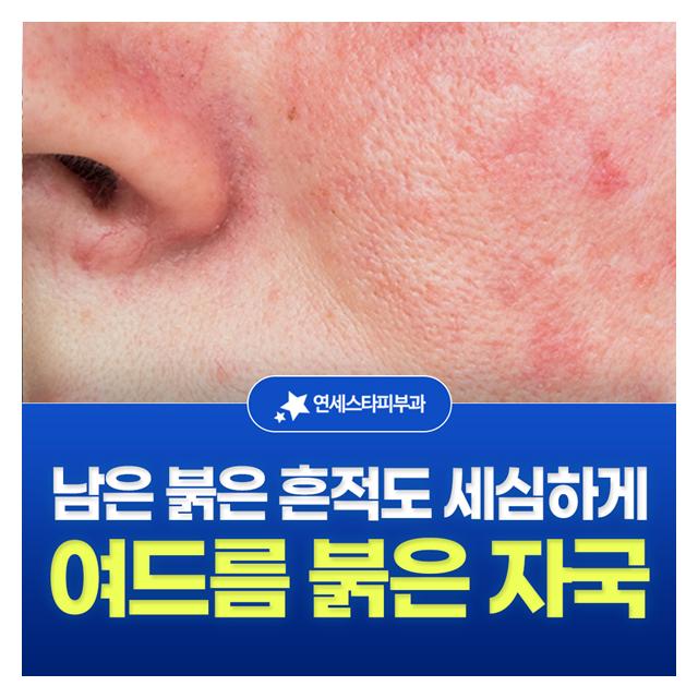 여드름 붉은 자국, 남은 붉은 흔적도 세심하게 진료하겠습니다