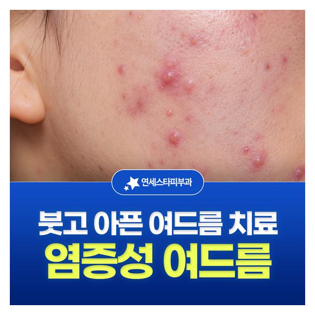 염증성 여드름, 붓고 아픈 여드름 치료도 걱정말고오세요