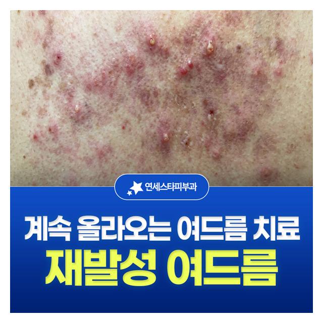 재발성 여드름, 올라오는 여드름 치료도 연세스타에서